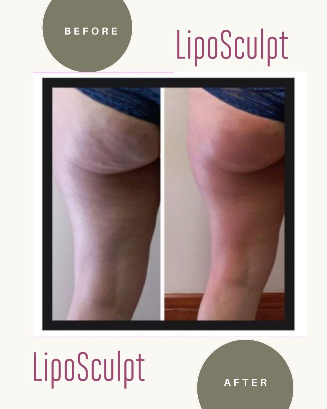 Liposculpt Transformation