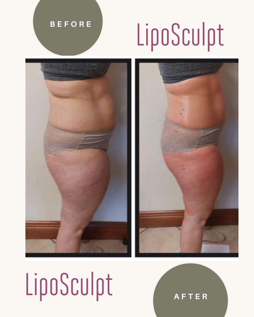 Liposculpt Transformation