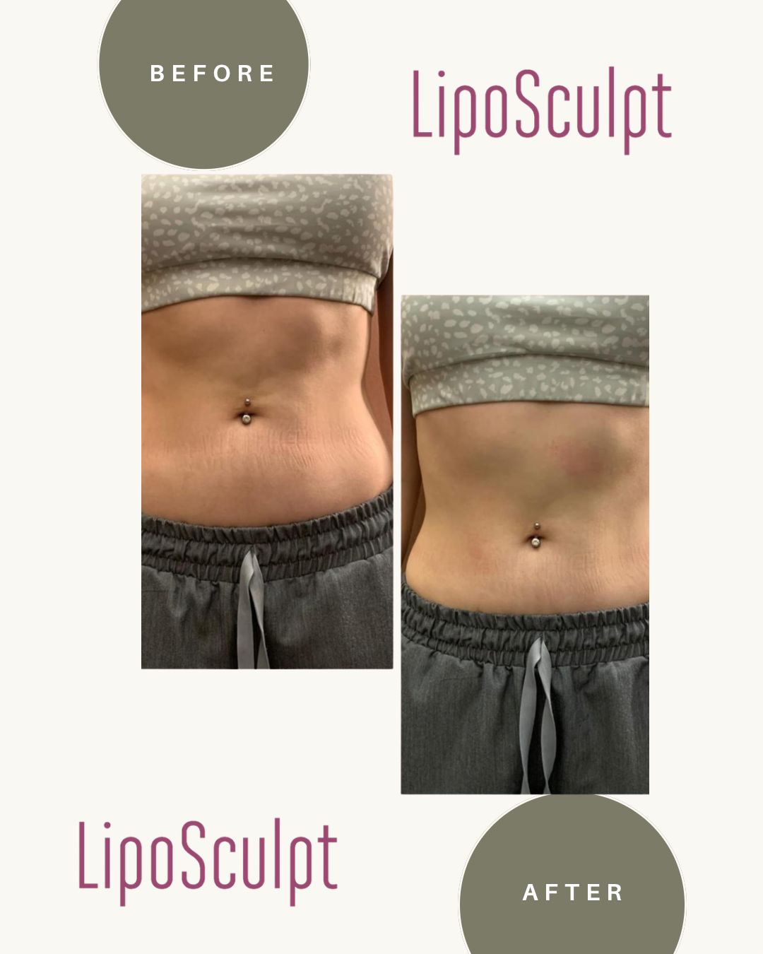 Liposculpt Transformation