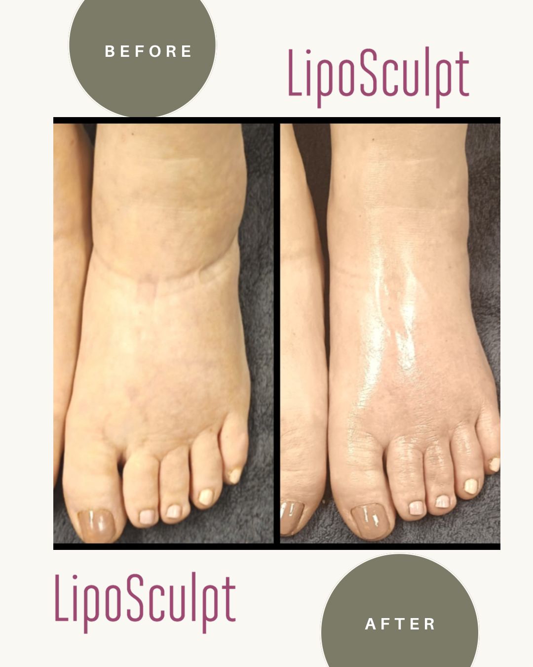 Liposculpt Transformation