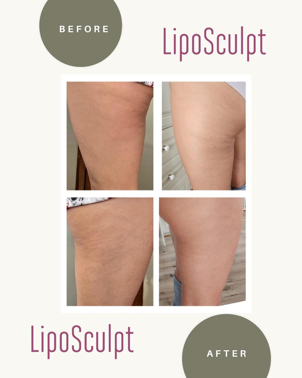 Liposculpt Transformation