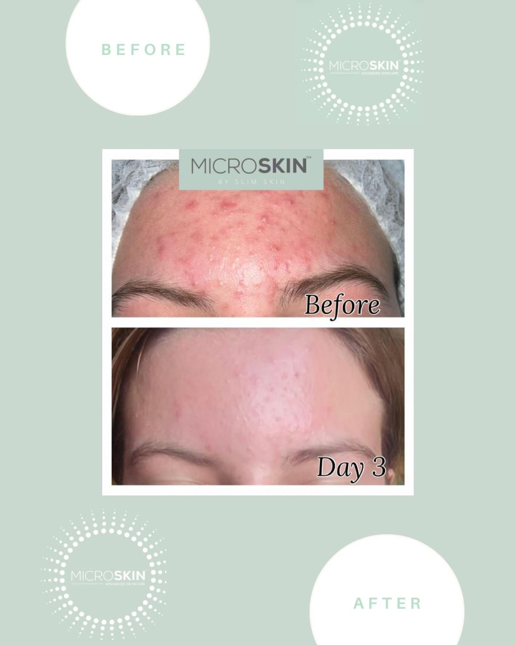 Microskin Transformation