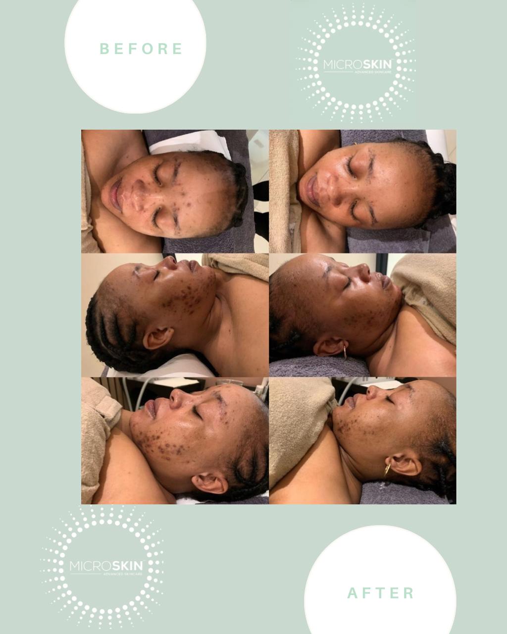 Microskin Transformation