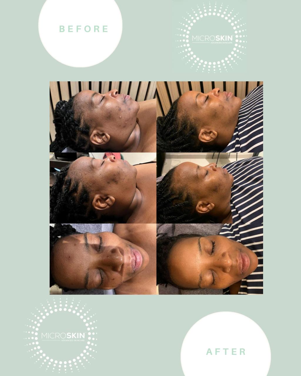 Microskin Transformation